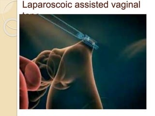 Laparoscoic assisted vaginal
tape
 