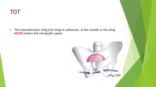 Sling for stress incontinence | PPTX