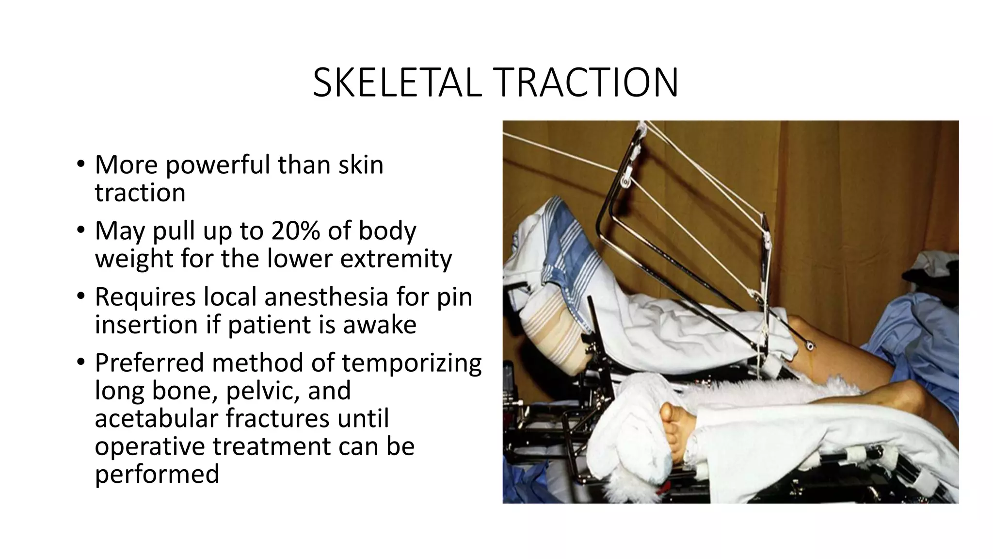 Splints and Tractions | PPTX