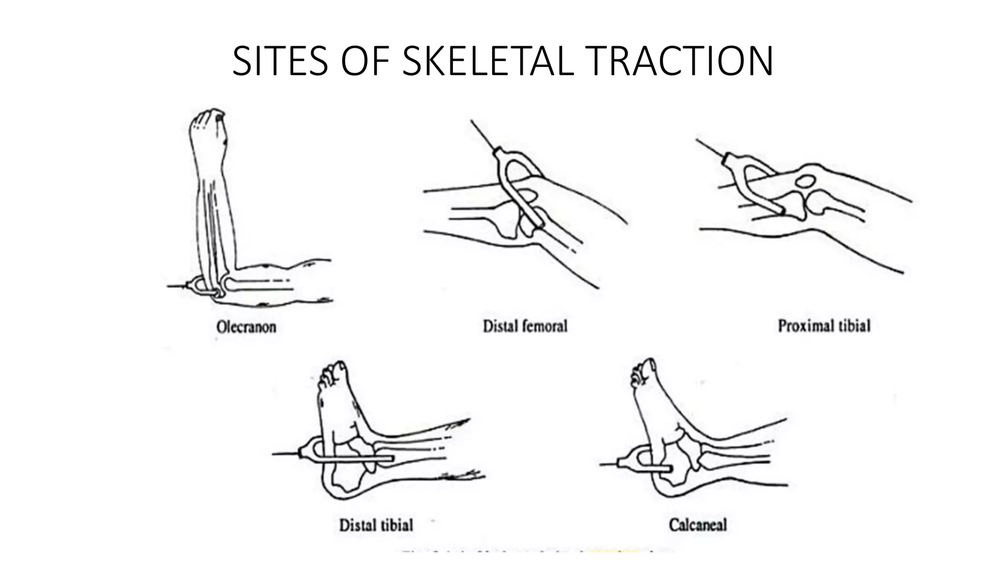 Traction Splint Examples Splints and Tractions | PPTX