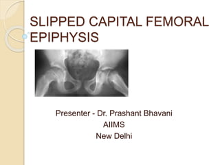 SLIPPED CAPITAL FEMORAL
EPIPHYSIS
Presenter - Dr. Prashant Bhavani
AIIMS
New Delhi
 