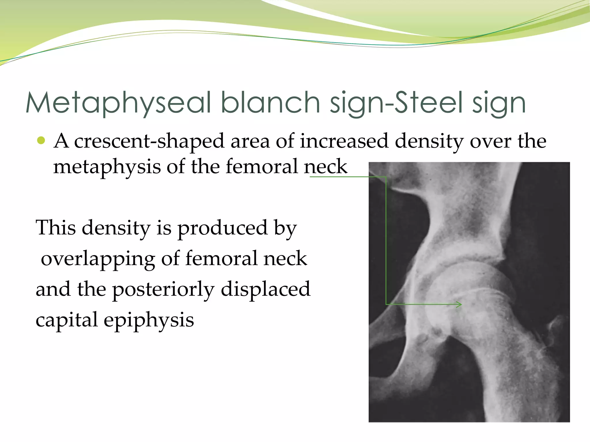 Slipped capital femoral epiphysis | PPTX