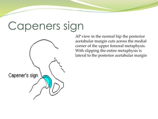 Slipped capital femoral epiphysis | PPTX