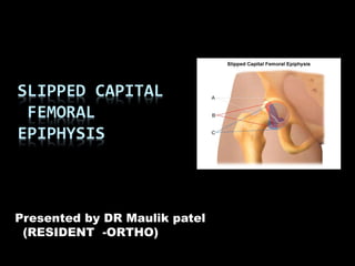 SLIPPED CAPITAL
FEMORAL
EPIPHYSIS
Presented by DR Maulik patel
(RESIDENT -ORTHO)
 