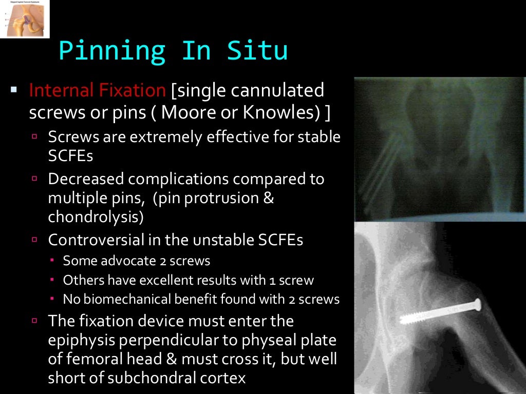 Slipped capital femoral epiphysis