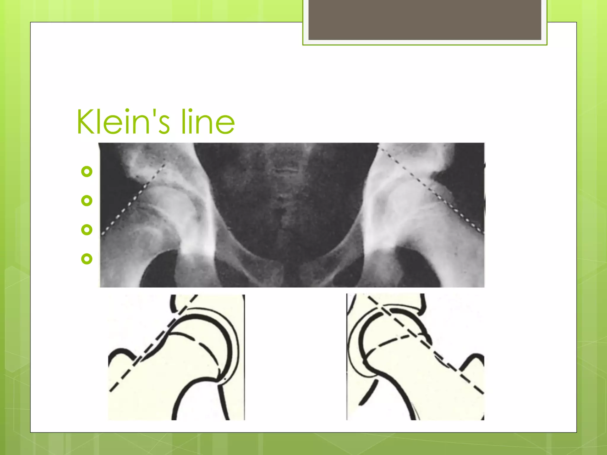 Scfe Line Slipped capital femoral epiphysis | PDF