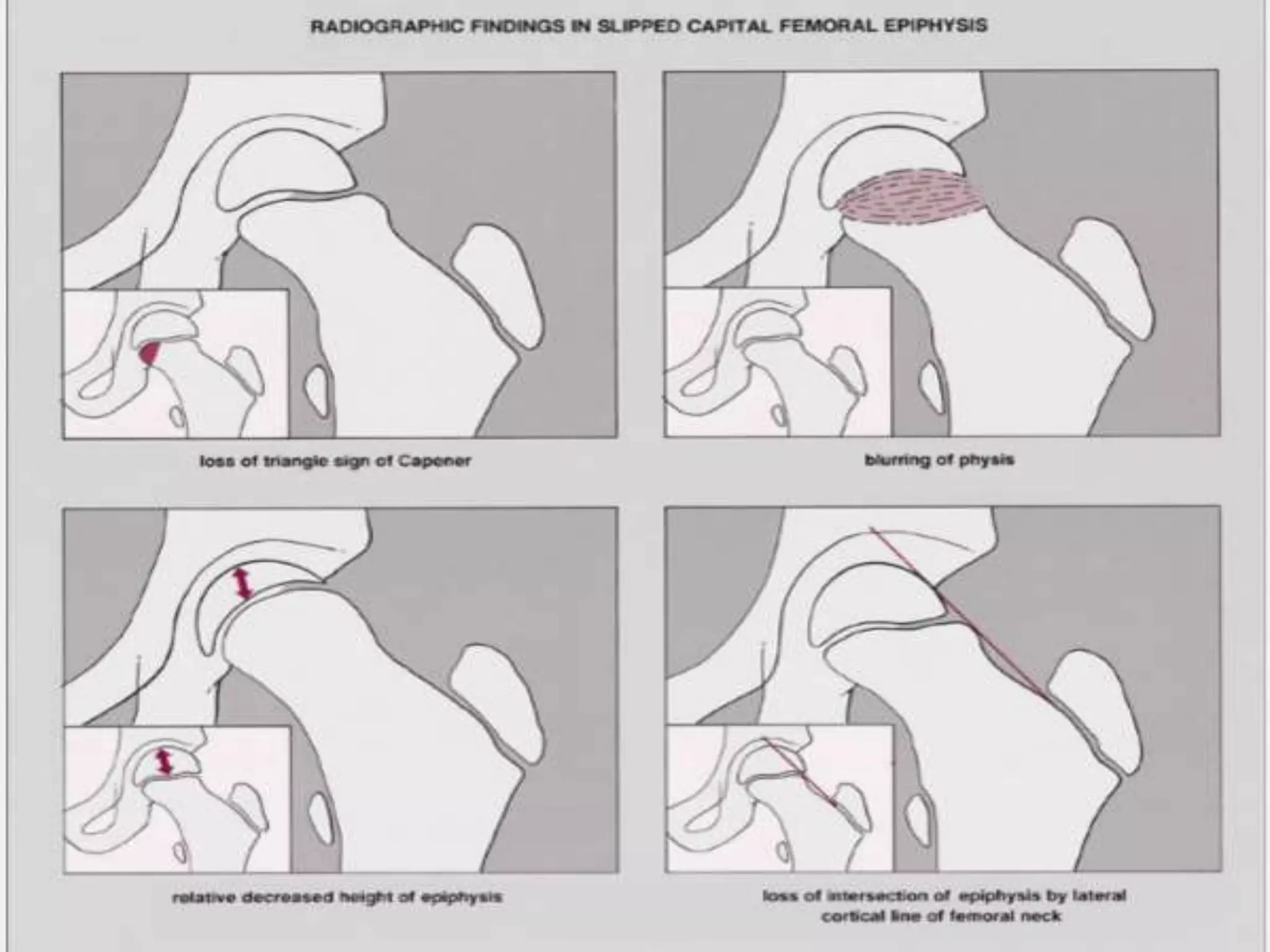 Slipped capital femoral epiphysis | PPTX