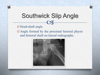 Slipped capital femoral epiphysis | PPT