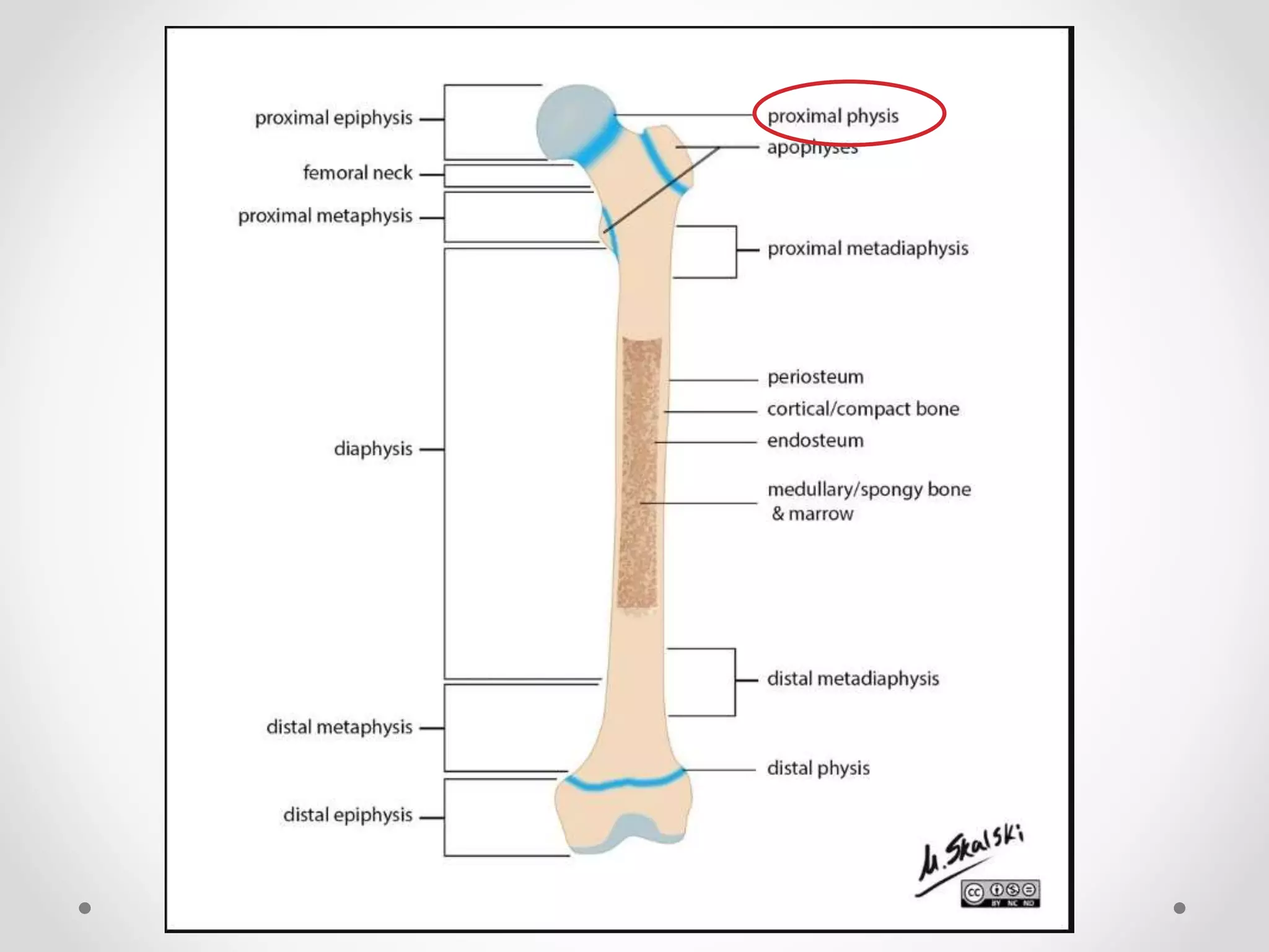 Slipped capital femoral epiphysis (scfe) | PPTX