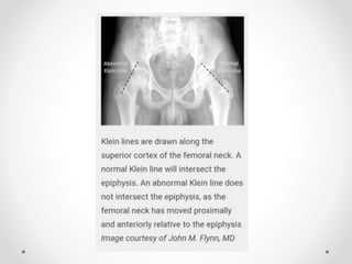 Scfe Line Slipped capital femoral epiphysis (scfe) | PPTX