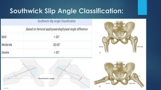 Slipped capital femoral epiphysis (SCFE).pptx
