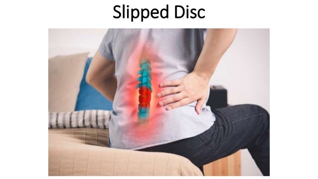 Ayurvedic Treatment for Slipped Disc | PPTX