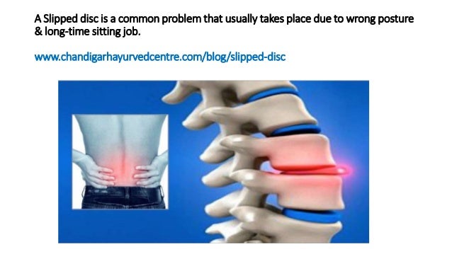 Ayurvedic Treatment for Slipped Disc | PPTX