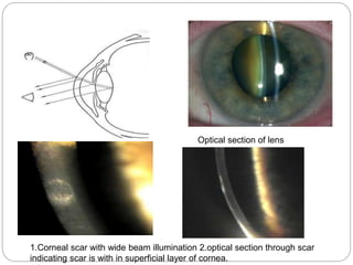 Optical section of lens
1.Corneal scar with wide beam illumination 2.optical section through scar
indicating scar is with in superficial layer of cornea.
 