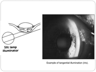 Example of tangential illumination (iris).
 