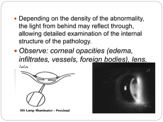  Depending on the density of the abnormality,
the light from behind may reflect through,
allowing detailed examination of the internal
structure of the pathology.
 Observe: corneal opacities (edema,
infiltrates, vessels, foreign bodies), lens,
iris
 