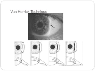 Van Herrick Technique
 