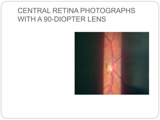 CENTRAL RETINA PHOTOGRAPHS
WITH A 90-DIOPTER LENS
 