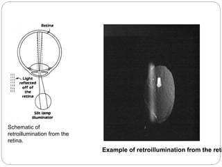 Schematic of
retroillumination from the
retina.
Example of retroillumination from the reti
 