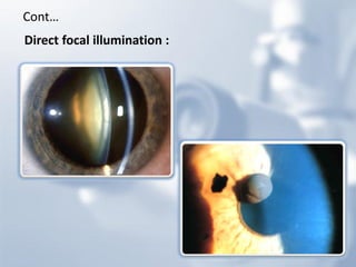 Slit lamp biomicroscope | PDF