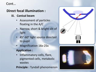 Direct focal illumination : 
iii.Conical beam 
•Assessment of particles floating in the A/C 
•Narrow, short & bright slit of light 
•45°-60° light source directed to pupil 
•Magnification 16x-25x 
Application : 
•Inflammatory cells, flare, pigmented cells, metabolic wastes 
Principle : Tyndall phenomenon 
Cont…  