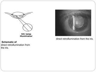 Schematic of
direct retroillumination from
the iris.
direct retroillumination from the iris.
 