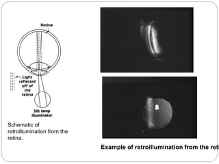 Schematic of
retroillumination from the
retina.
Example of retroillumination from the reti
 