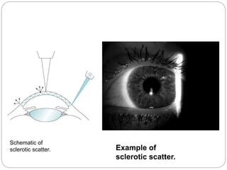 Schematic of
sclerotic scatter. Example of
sclerotic scatter.
 