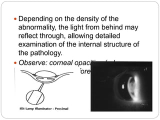  Depending on the density of the
abnormality, the light from behind may
reflect through, allowing detailed
examination of the internal structure of
the pathology.
 Observe: corneal opacities (edema,
infiltrates, vessels, foreign bodies), lens,
iris
 