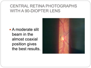 CENTRAL RETINA PHOTOGRAPHS
WITH A 90-DIOPTER LENS
 A moderate slit
beam in the
almost coaxial
position gives
the best results.
 