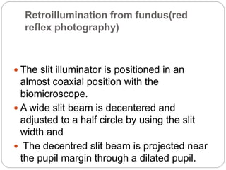 Retroillumination from fundus(red
reflex photography)
 The slit illuminator is positioned in an
almost coaxial position with the
biomicroscope.
 A wide slit beam is decentered and
adjusted to a half circle by using the slit
width and
 The decentred slit beam is projected near
the pupil margin through a dilated pupil.
 