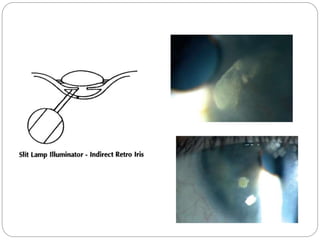 Slit  Lamp Biomicroscopy Slide 54