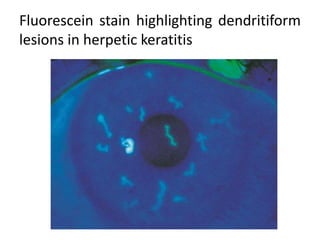 Fluorescein stain highlighting dendritiform
lesions in herpetic keratitis
 