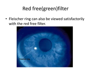 Red free(green)filter
• Fleischer ring can also be viewed satisfactorily
with the red free filter.
 