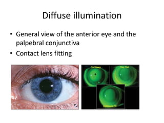 Diffuse illumination
• General view of the anterior eye and the
palpebral conjunctiva
• Contact lens fitting
 