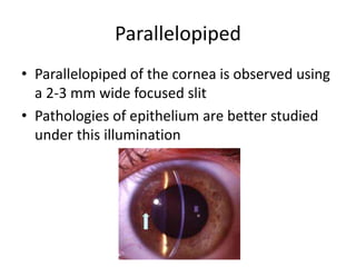 Parallelopiped
• Parallelopiped of the cornea is observed using
a 2-3 mm wide focused slit
• Pathologies of epithelium are better studied
under this illumination
 