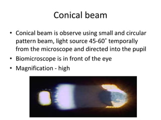 Conical beam
• Conical beam is observe using small and circular
pattern beam, light source 45-60˚ temporally
from the microscope and directed into the pupil
• Biomicroscope is in front of the eye
• Magnification - high
 