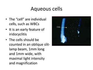 Aqueous cells
• The “cell” are individual
cells, such as WBCs
• It is an early feature of
iridocyclitis
• The cells should be
counted in an oblique slit-
lamp beam, 1mm long
and 1mm wide, with
maximal light intensity
and magnification
 