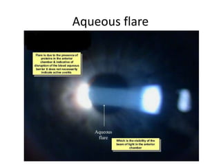 Aqueous flare
 