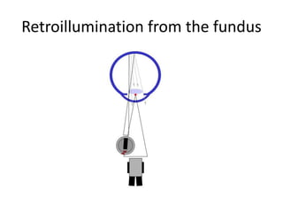 Retroillumination from the fundus
 