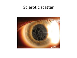 Sclerotic scatter
 