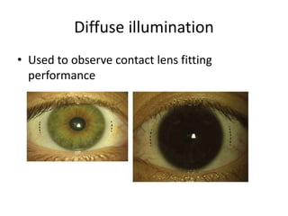 Diffuse illumination
• Used to observe contact lens fitting
performance
 