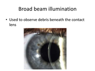 Broad beam illumination
• Used to observe debris beneath the contact
lens
 