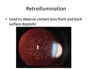 Retroillumination
• Used to observe contact lens front and back
surface deposits
 