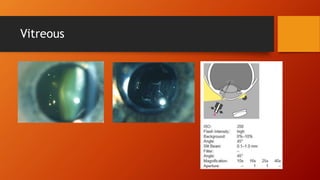 Vitreous 
 