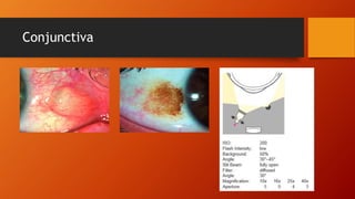 Conjunctiva 
 