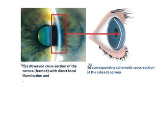 (a) Observed cross-section of the
cornea (framed) with direct focal
illumination and
.
(b) corresponding schematic cross-section
of the (sliced) cornea
 
