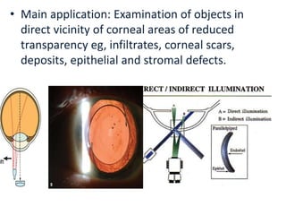 • Main application: Examination of objects in
direct vicinity of corneal areas of reduced
transparency eg, infiltrates, corneal scars,
deposits, epithelial and stromal defects.
 