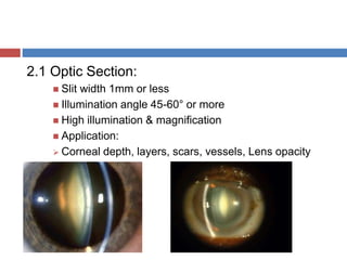 2.1 Optic Section:
 Slit width 1mm or less
 Illumination angle 45-60° or more
 High illumination & magnification
 Application:
 Corneal depth, layers, scars, vessels, Lens opacity
 