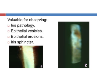 Valuable for observing:
 Iris pathology.
 Epithelial vesicles.
 Epithelial erosions.
 Iris sphincter.
 
